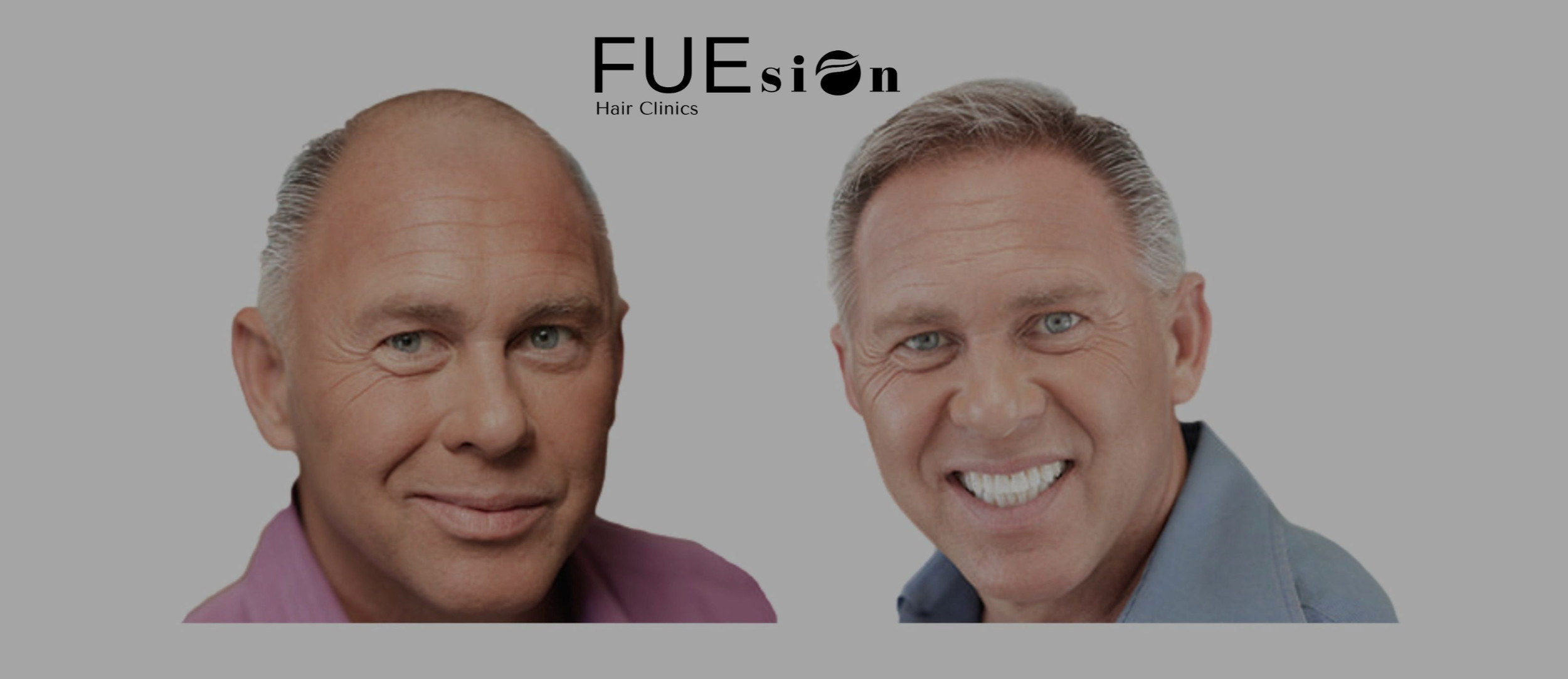 FUEsion Hair Clinics