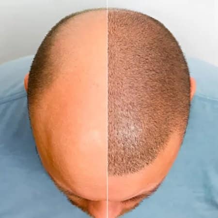Best Hair Transplants Los Angeles