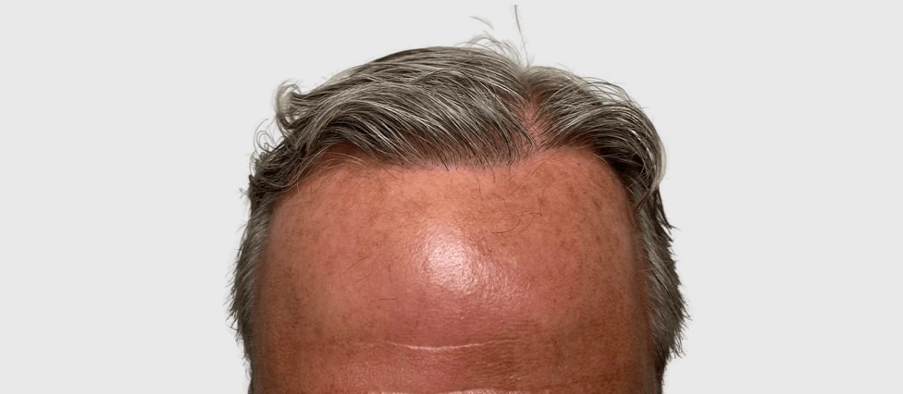 Maxim Hair Restoration & Transplants - Philadelphia