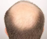 Physicians' Hair Restoration Center - PHRC