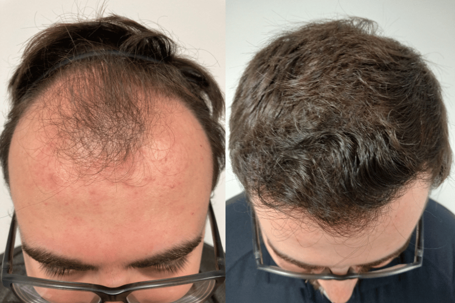 Philadelphia Hair Restoration